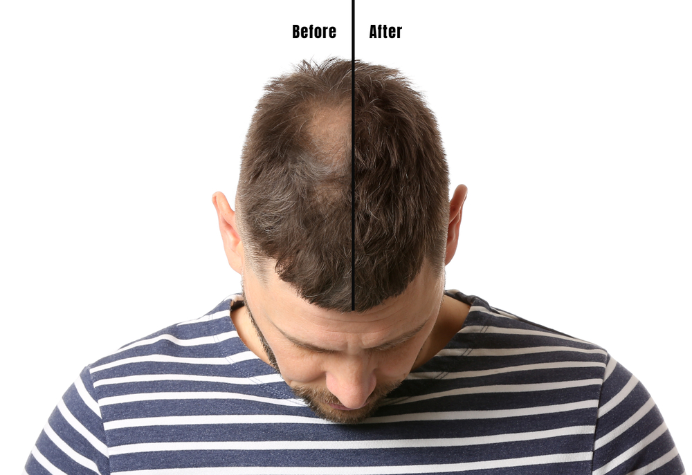 Saç Dökülmesi Tedavileri